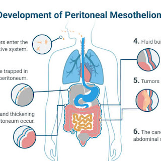 peritoneal mesothelioma specialists