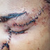 Herida con un bisturí por 3 mujeres y dos hombres, En Ejido Santiago.