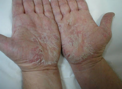 Dermatitis Kronis Pada Tangan