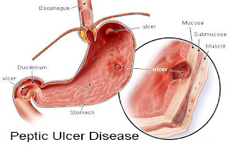 Ulcer Symptom