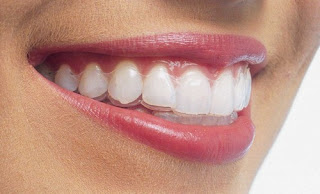 niềng răng Invisalign không mắc cài