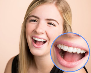 Niềng răng invisalign có đau không-1