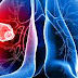 What is Mesothelioma Cancer?