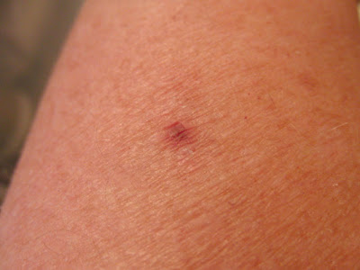 spider bite pictures blister. spider bite pictures lister.