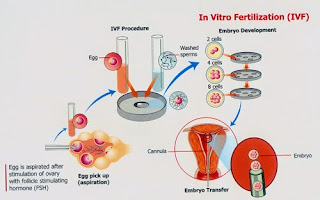 IVF Sexology Doctor Treatment Clinic in Chennai