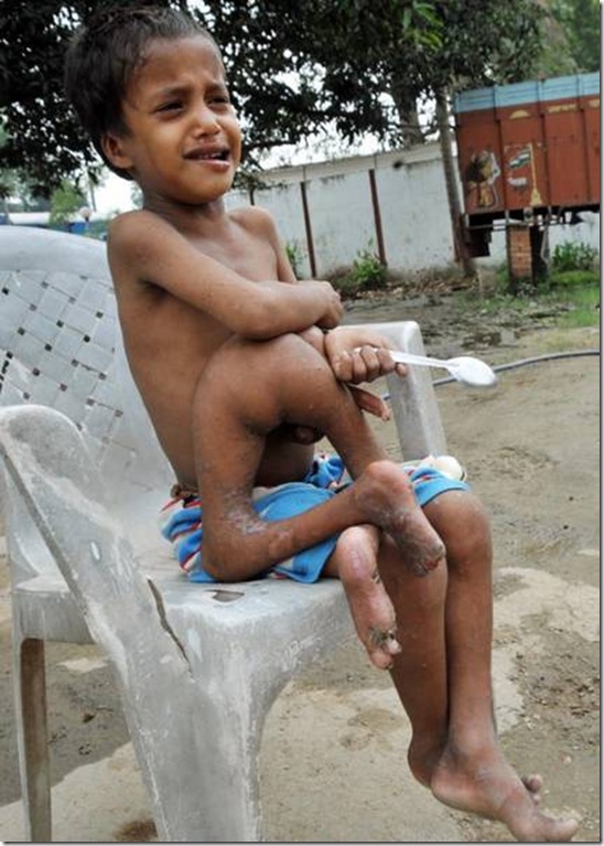 India´s octo-limbo kid wants help