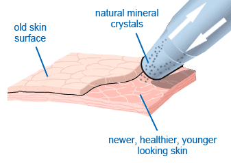 Microdermabrasion ลบรอยสิวที่หลัง