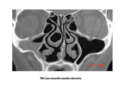 TAC sinusitis maxilar