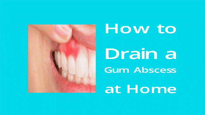 How to drain a gum abscess at home