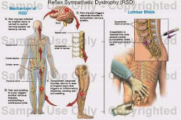  Reflex Sympathetic Dystrophy