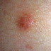 Bikini bumps that wont go away - About