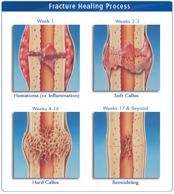 Proses penyembuhan fraktur normal