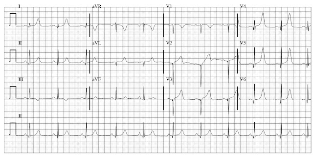 ECG of hypertrophic cardiomyopathy HCM