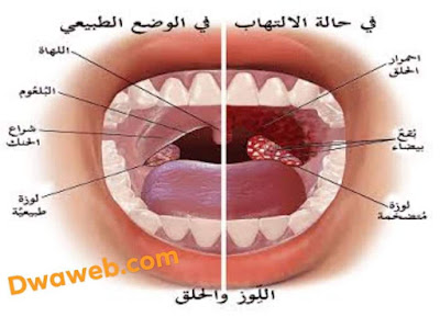 التهاب الحلق وعلاجه بالمنزل