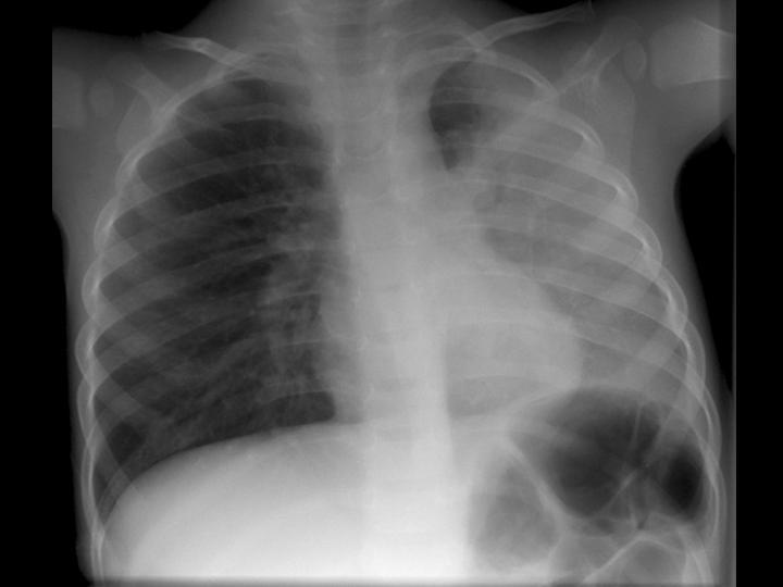 Iklas iryadi iklas berbagi Pneumonia lobaris Referat 