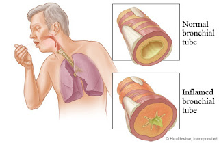 Bronchitis Warning Signs