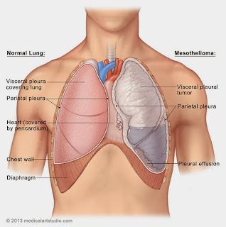 Mesothelioma And Pulmonary Decortication