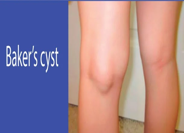 Baker's Cyst: Pain Behind the Knee