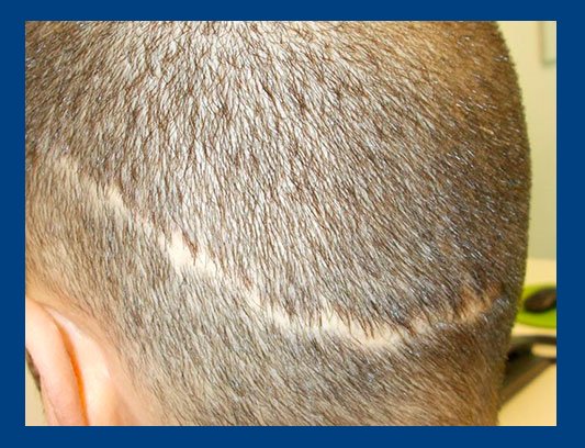 Alopell Clinic. Blog: ALOPECIA CICATRICIAL