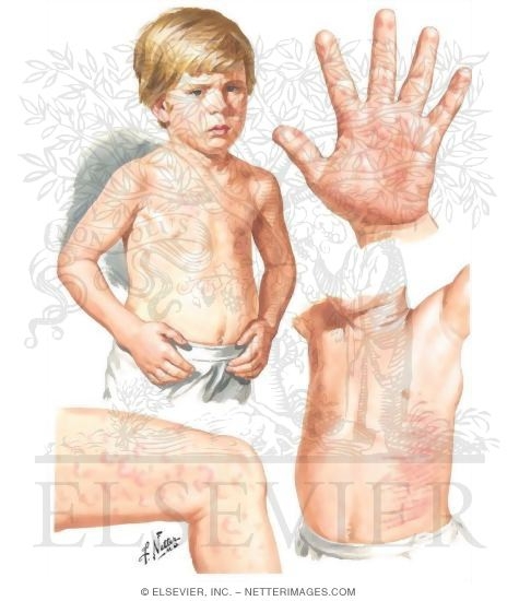 Juvenile Rheumatoid Arthritis Rash