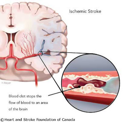 Ischemic stroke is caused by