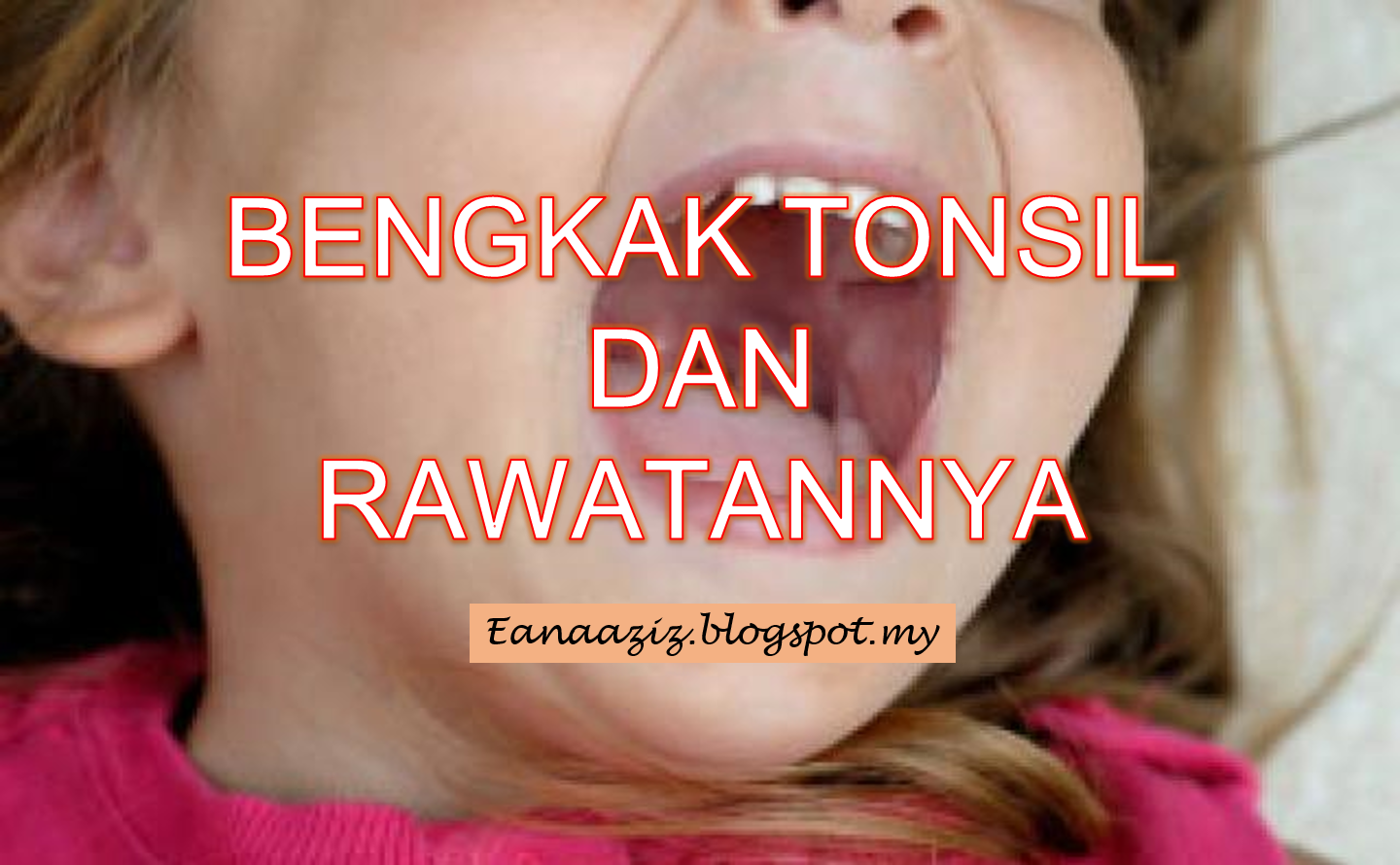 Pengalaman Kerap Kali Diserang Bengkak Tonsil - eanaaziz