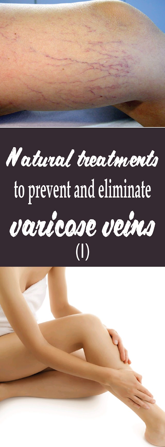 Natural treatments to prevent and eliminate varicose veins