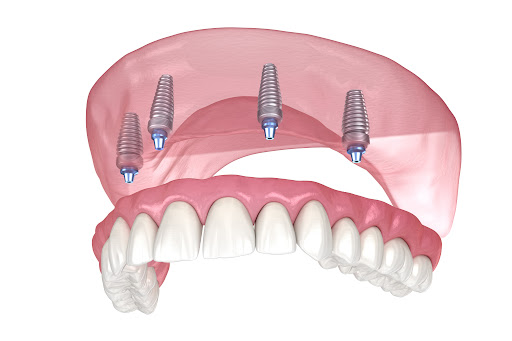 How All-on-4® Can Improve Your Smile