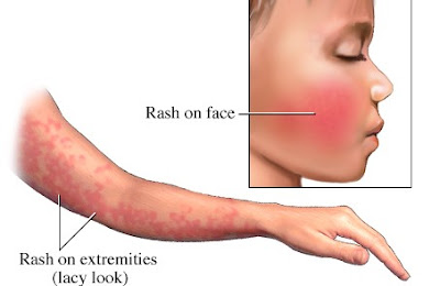 Fifth Disease Rash Pictures