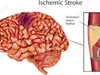 Terkena Sakit Stroke Ringan Apakah Bisa Sembuh?