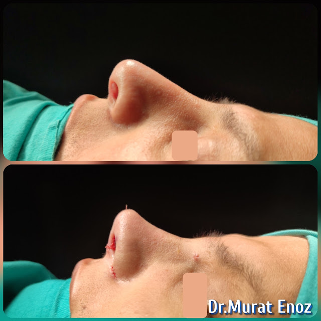 Tertiary Revision Nose Job Rib Cartilage Grafts Removal