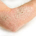 6 Tips untuk kulit kering bersisik dan gatal secara alami