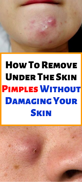 How To Remove Under The Skin Pimples Without Damaging Your Skin