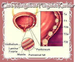 Cara Mengobati Penyakit Kanker