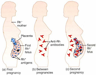 Biologi: Kelainan/Penyakit Pada Sistem Peredaran Darah 