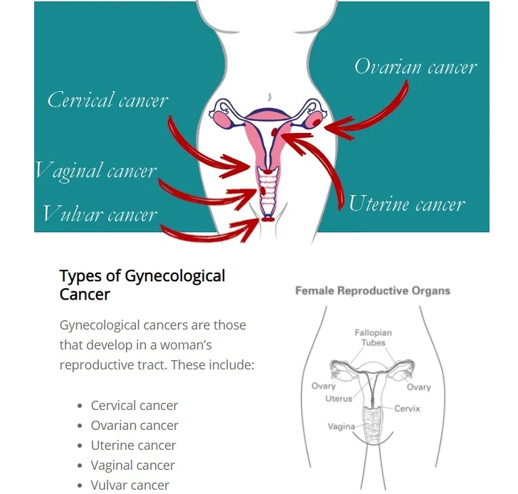 Gynecological Cancer