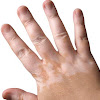   Vitiligo, Kelainan Bercak Putih di Tubuh