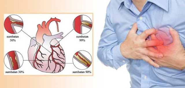 Penyakit Jantung Koroner dan Upaya Mecegah serta Menanggulanginya