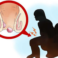 Obat Wasir Dan Ambeien Alami