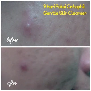 Pengalamanku Pakai Cetaphil Gentle Skin Cleanser Tanpa Busa.