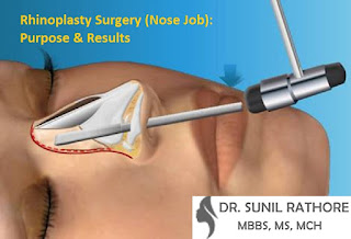 http://bhopalplasticsurgery.com/rhinoplasty-surgery.html