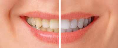  Gigi putih dan mengkilap merupakan penunjang atau pendukung penampilan seseorang Gigi Kuning Akibat Kopi & Perokok Berat, Atasi Dengan Bahan Ini!