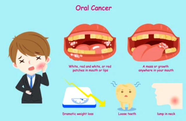 Understanding Oral Cancer Causes Exploring the Risk Factors