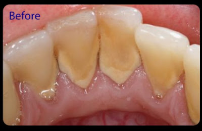 Cao răng hóa đá nguyên nhân gây mất răng