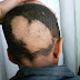 ریزش موی ساحوی alopecia areata