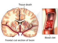 Cara Alami Mengobati Stroke Ringan