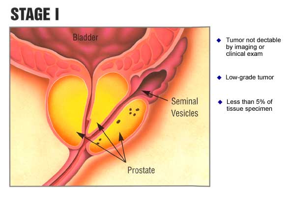 Images Prostate Cancer