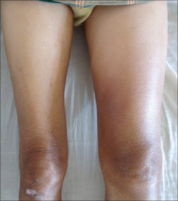 What causes swelling in the legs,swelling in legs causes,swelling in legs treatment
