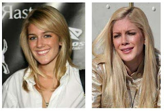 Heidi Montag Plastic Surgery Photos