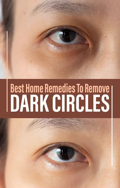 Dark Circles Under The Eyes: Causes, Symptoms, And Treatment Options